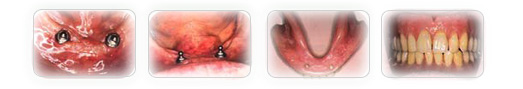 Implanti Stomatologija